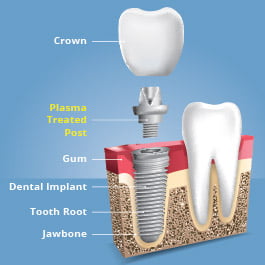 Plasma treatment of dental implants creates stronger bonds